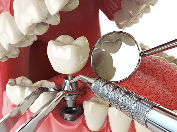 Best Lost Filling or Crown Replacement in Stanley, VA
